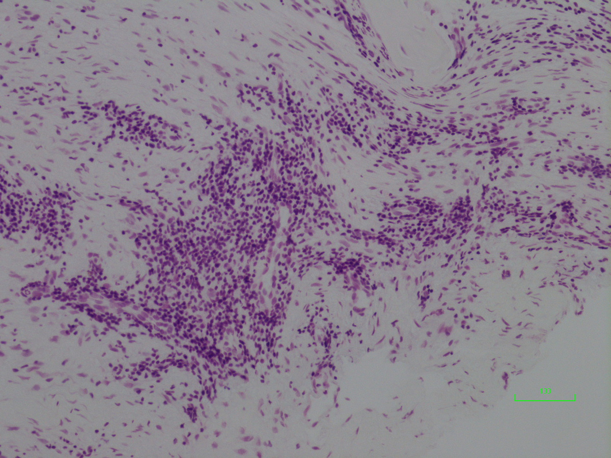 Bone marrow, 100x